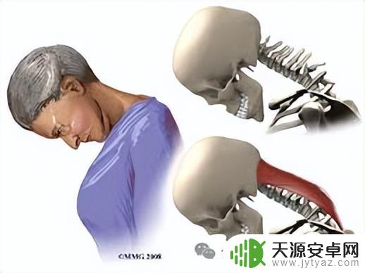 日本25岁男子因长时间玩手机,导致脖子弯曲对折,情况紧急!