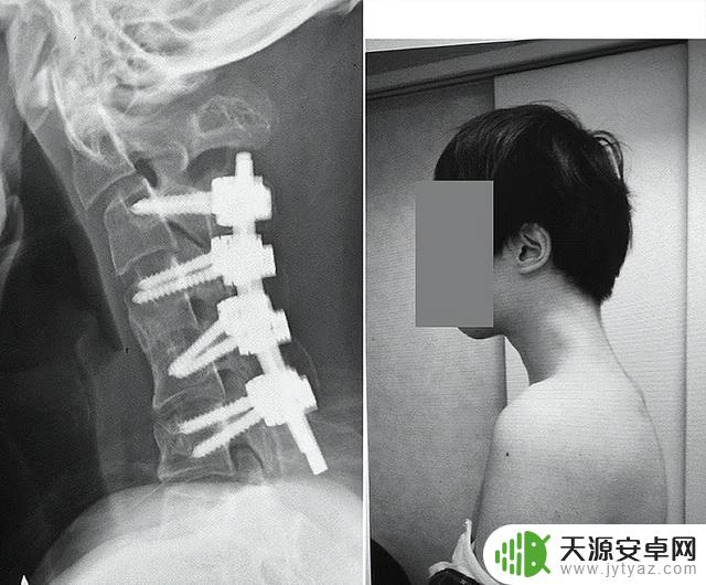 日本25岁男子因长时间玩手机,导致脖子弯曲对折,情况紧急!