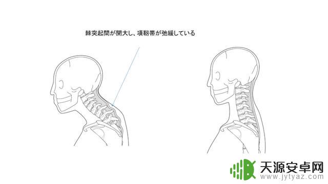 日本25岁男子因长时间玩手机,导致脖子弯曲对折,情况紧急!